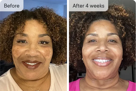 Olivia's skin before and after 4 weeks of treatment.