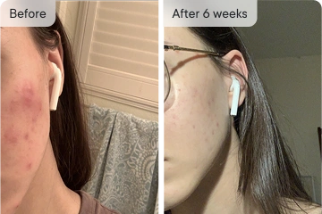 Vanessa's acne treatment before and after 6 weeks