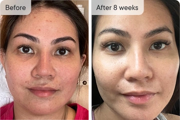 White-C skin before and after 8 weeks